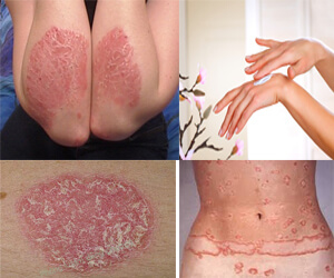 Biểu hiện của bệnh vảy phấn hồng