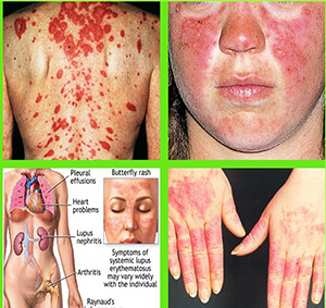 Bệnh lupus ban đỏ có lây không?