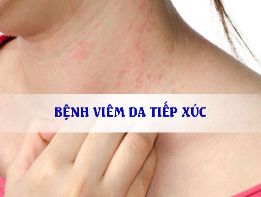 Tác hại bệnh viêm da tiếp xúc gây ra