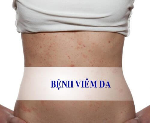 Tác hại của bệnh viêm da thần kinh