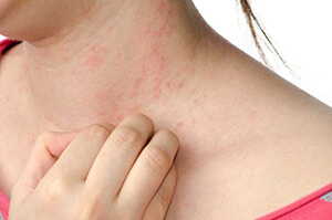 Tác hại không nhỏ của viêm da