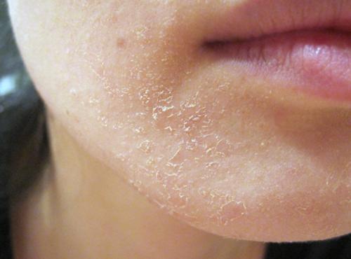 Tác hại do bệnh vảy cá gây ra