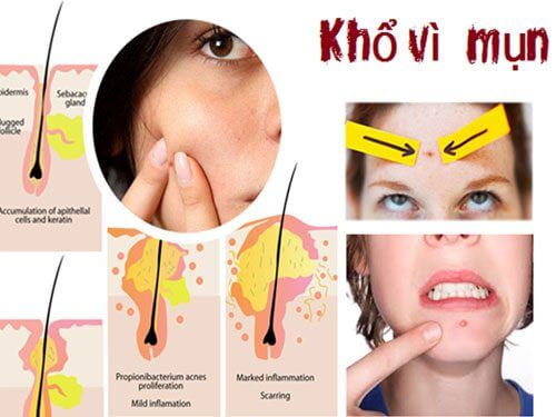 Phương pháp xử lý mụn trứng cá 