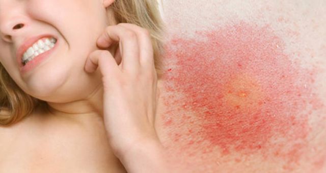 Làm gì để khống chế dị ứng da