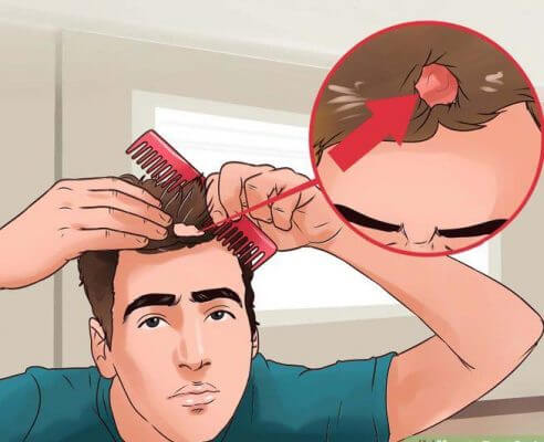 Nhận biết dấu hiệu nhận biết nấm đầu