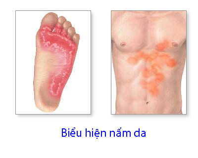 Nấm da có nguy hiểm không?