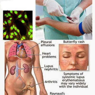 Dấu hiệu của bệnh Lupus ban đỏ