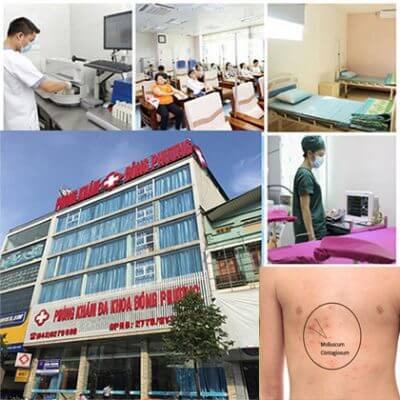 U mềm lây nên đi đâu để khám