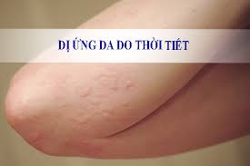 Dị ứng thời tiết phải làm sao
