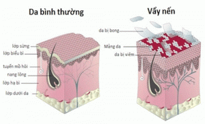 Triệu chứng thường thấy của bệnh vảy nến