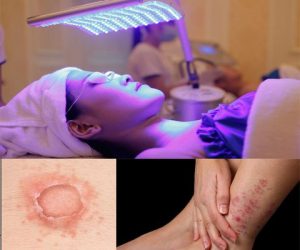 Triệu chứng thường thấy của bệnh vảy nến