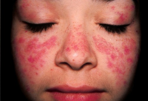 lupus-ban-do-1
