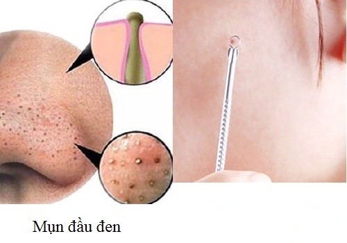 cach-nam-mun-dau-den-dung-cach