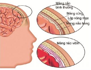 viem_mang_nao_mo_cau_3