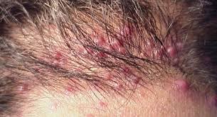 Tìm hiểu về viêm da đầu