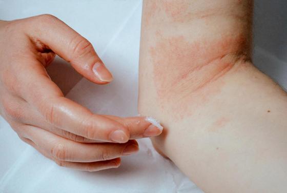 Tác hại của bệnh dị ứng da